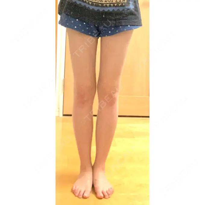 脂肪吸引（脚） ヨンセスリムライン AFTER メイン用