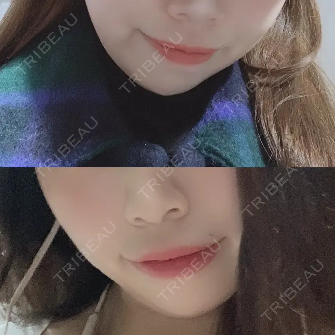 ヒアルロン酸注入（唇） ルラ美容クリニック 高田馬場院 DAY 2 メイン用