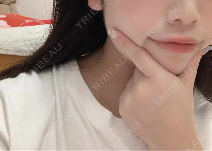 ヒアルロン酸注入（唇） ルラ美容クリニック 高田馬場院 DAY 4 メイン用