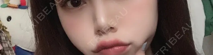 ヒアルロン酸注入（唇） ルラ美容クリニック 高田馬場院 AFTER メイン用