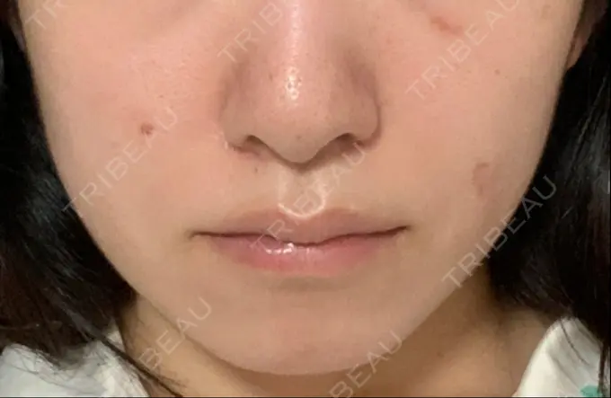 ボトックス（エラ・小顔） TCB東京中央美容外科 郡山院 DAY 120 メイン用