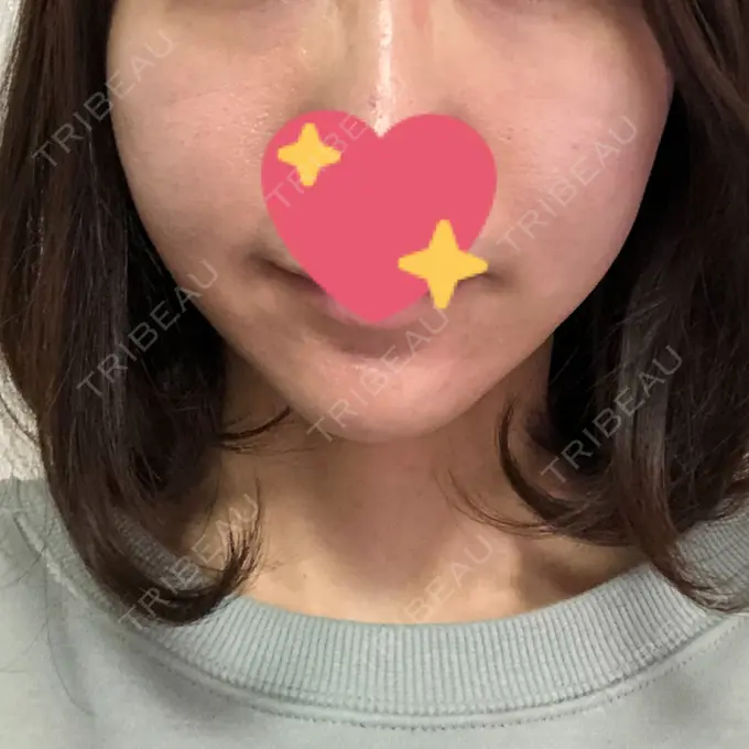 糸リフト / ヒアルロン酸注入（あご） / ボトックス（エラ・小顔） 大阪TAクリニック DAY 1 メイン用