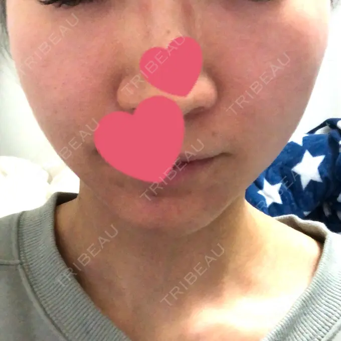 糸リフト / ヒアルロン酸注入（あご） / ボトックス（エラ・小顔） 大阪TAクリニック DAY 1 メイン用