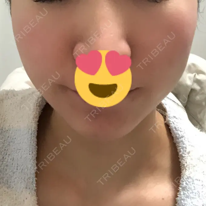 糸リフト / ヒアルロン酸注入（あご） / ボトックス（エラ・小顔） 大阪TAクリニック DAY 7 メイン用