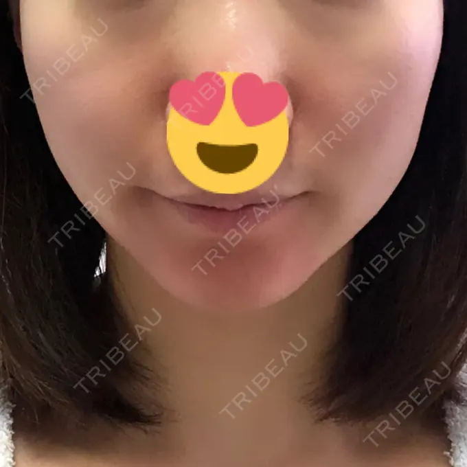 糸リフト / ヒアルロン酸注入（あご） / ボトックス（エラ・小顔） 大阪TAクリニック DAY 10 メイン用