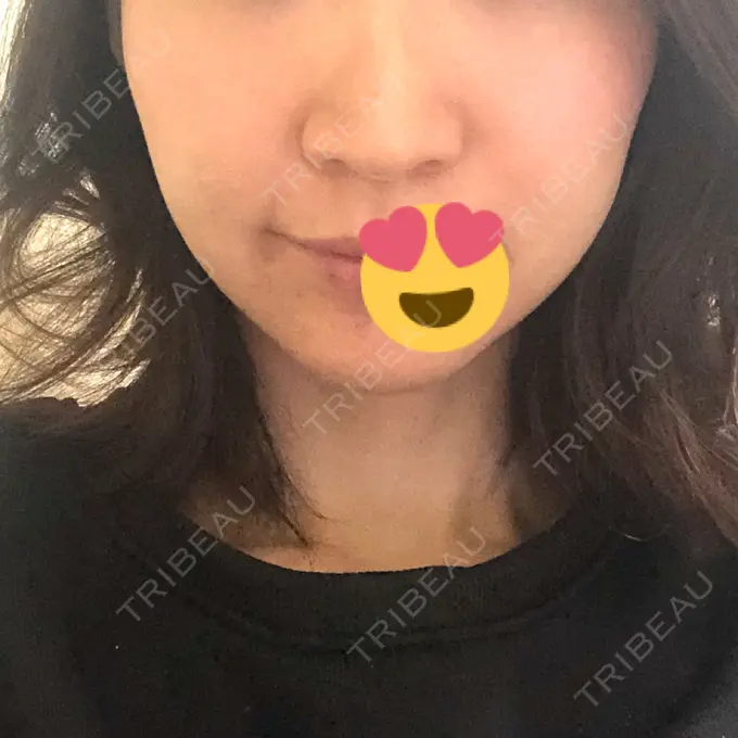 糸リフト / ヒアルロン酸注入（あご） / ボトックス（エラ・小顔） 大阪TAクリニック DAY 20 メイン用