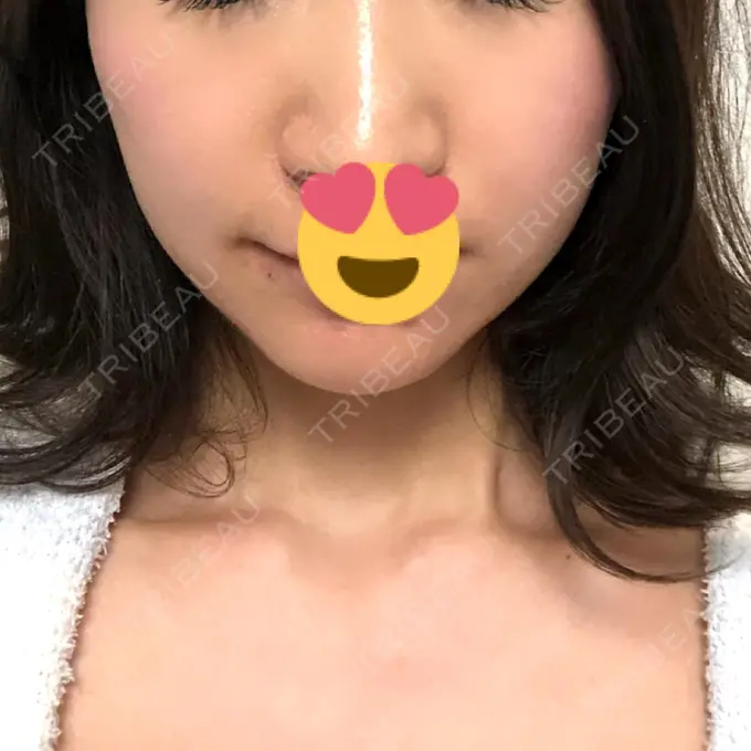 糸リフト / ヒアルロン酸注入（あご） / ボトックス（エラ・小顔） 大阪TAクリニック DAY 31 メイン用