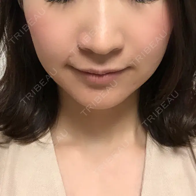 糸リフト / ヒアルロン酸注入（あご） / ボトックス（エラ・小顔） 大阪TAクリニック AFTER メイン用