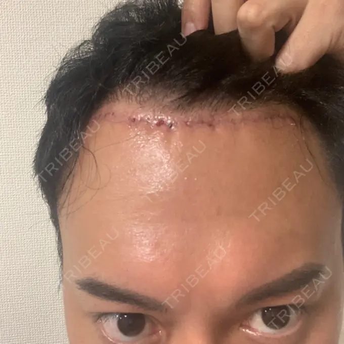 その他（輪郭） スタート整形外科 DAY 15 メイン用