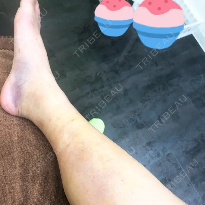 その他（ボディ） 湘南美容クリニック 仙台院 DAY 7 メイン用