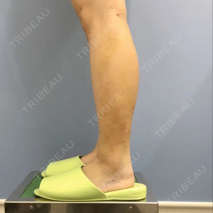 その他（ボディ） 湘南美容クリニック 仙台院 DAY 10 メイン用