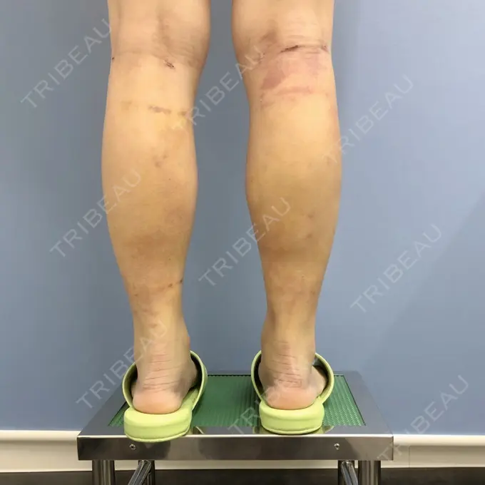 その他（ボディ） 湘南美容クリニック 仙台院 DAY 10 メイン用