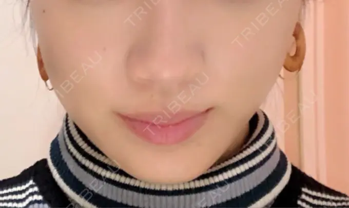 糸リフト 大阪TAクリニック AFTER メイン用