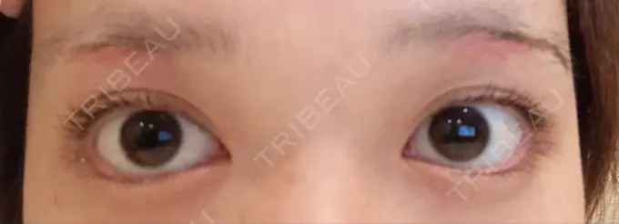 眉下切開 / その他（目元） 湘南美容クリニック 秋葉原院 DAY 12 メイン用