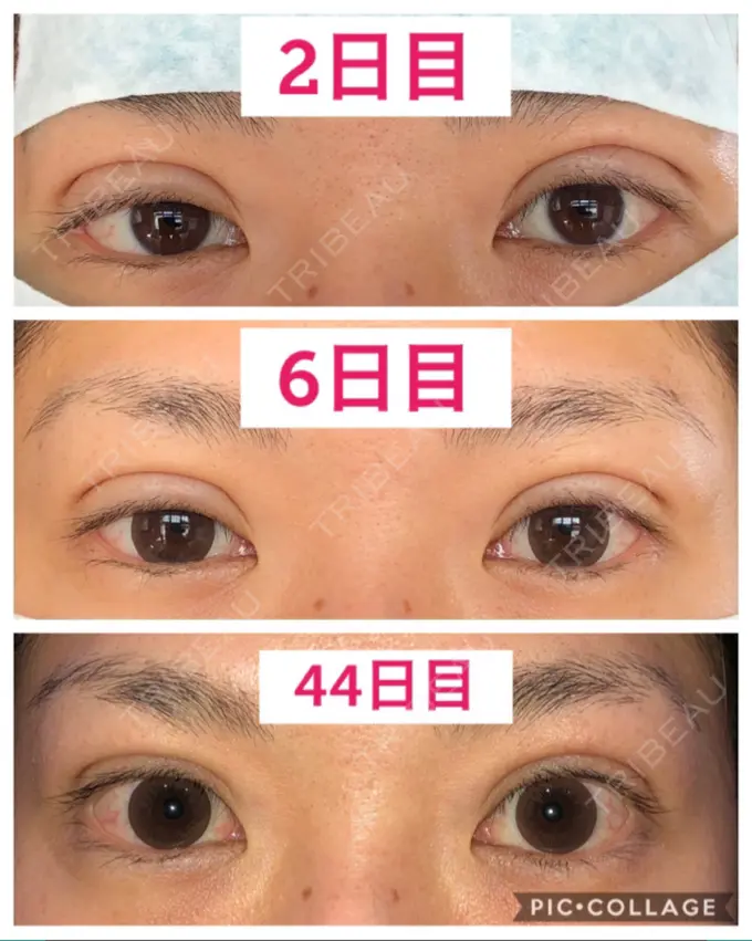 二重埋没 湘南美容クリニック 京都院 DAY 44 メイン用