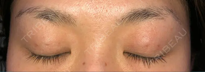 二重埋没 湘南美容クリニック 京都院 DAY 44 メイン用