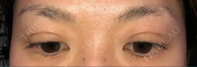 二重埋没 湘南美容クリニック 京都院 DAY 44 メイン用