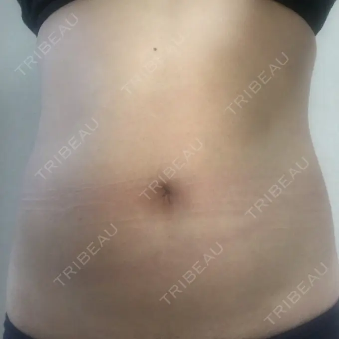 その他（ボディ） 品川美容外科 仙台院 DAY 35 メイン用