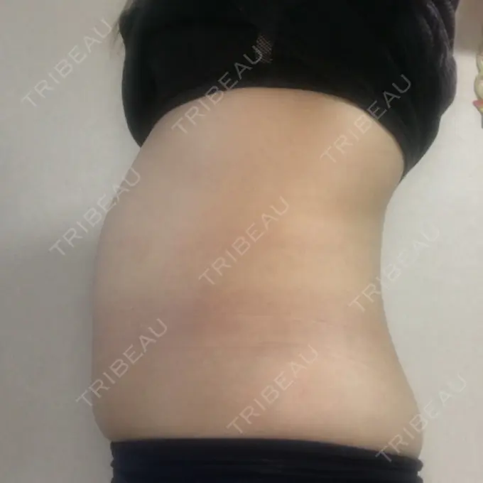 その他（ボディ） 品川美容外科 仙台院 DAY 35 メイン用