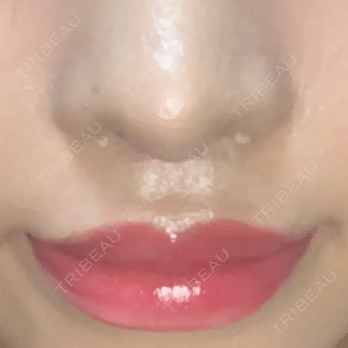 人中短縮 新宿ラクル美容外科クリニック 新宿院 DAY 46 メイン用