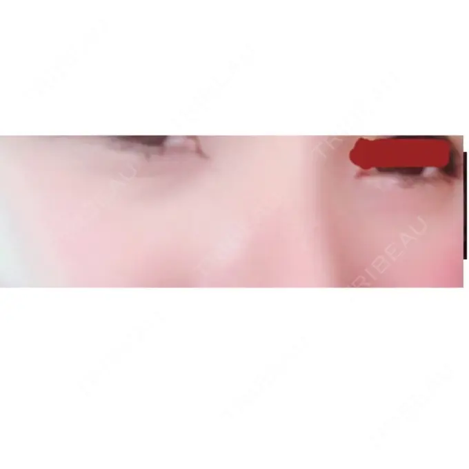 下まぶたたるみ取り 東京形成美容外科 船橋院 DAY 31 メイン用