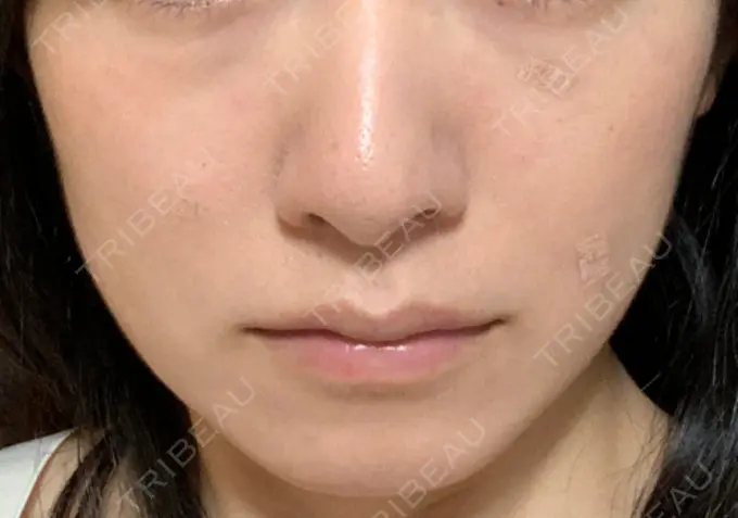 ボトックス（エラ・小顔） TCB東京中央美容外科 郡山院 DAY 129 メイン用