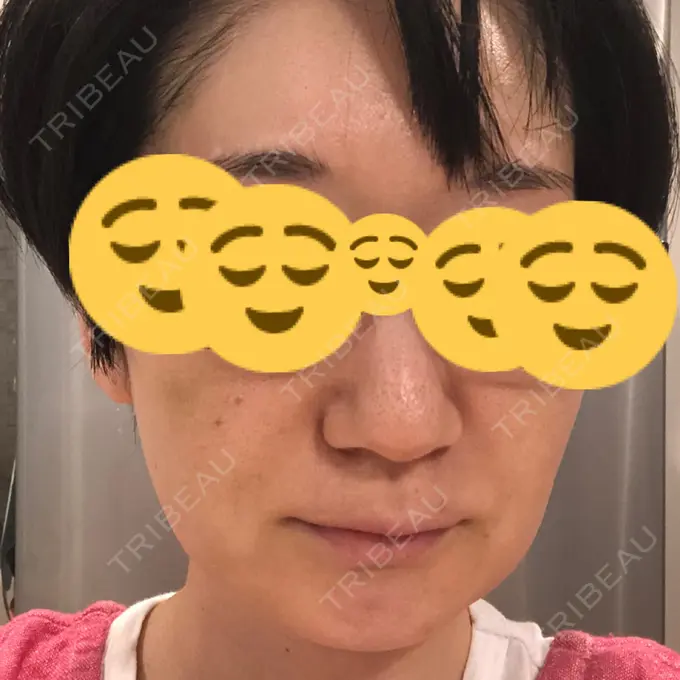 バッカルファット除去 / 脂肪吸引（顔） ジョウクリニック 大阪院 DAY 14 メイン用