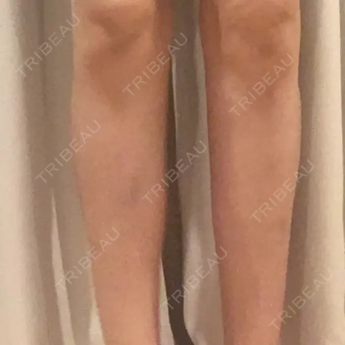 その他（ボディ） アサミ美容外科 渋谷院 DAY 31 メイン用