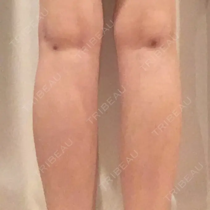 その他（ボディ） アサミ美容外科 渋谷院 DAY 31 メイン用