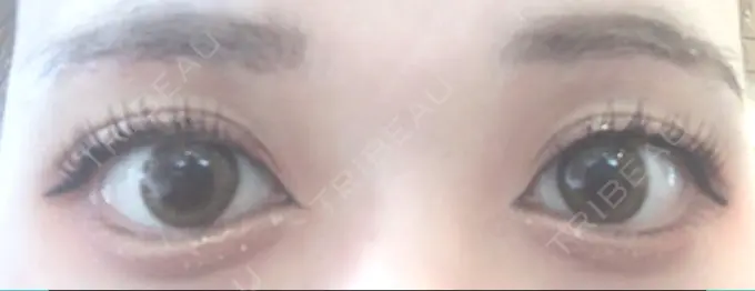 眉下切開 / その他（目元） 湘南美容クリニック 秋葉原院 DAY 15 メイン用