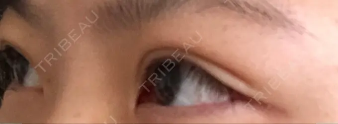 二重埋没 湘南美容クリニック 京都院 DAY 3 メイン用