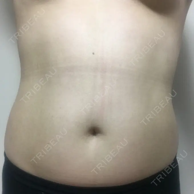 その他（ボディ） 品川美容外科 仙台院 DAY 38 メイン用