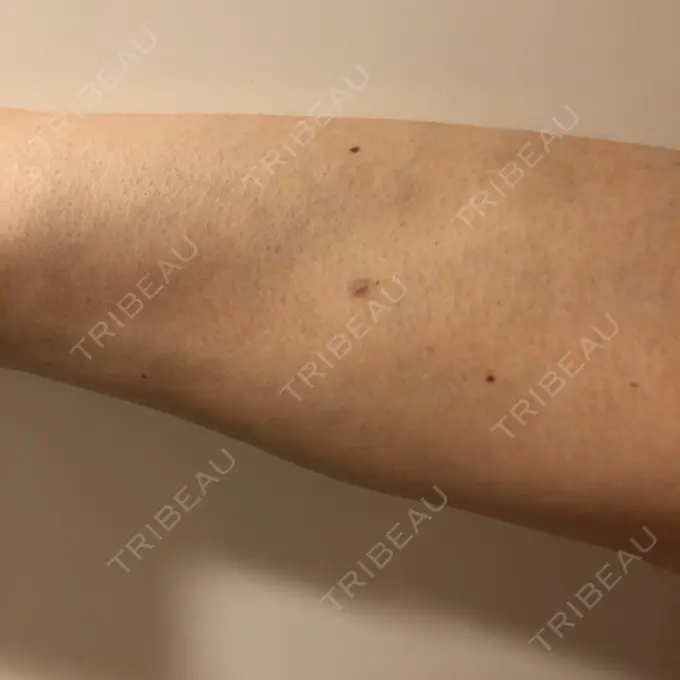 ほくろ・いぼ切除（肌） やさしい美容皮膚科・皮フ科　秋葉原院 DAY 150 メイン用