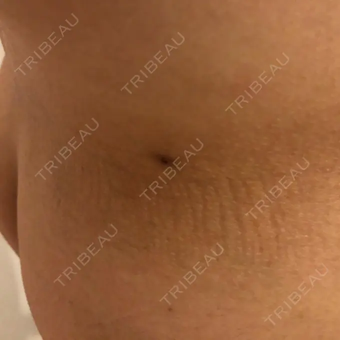 ほくろ・いぼ切除（肌） やさしい美容皮膚科・皮フ科　秋葉原院 DAY 150 メイン用