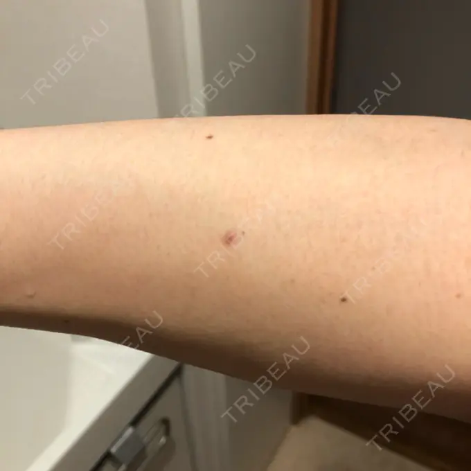 ほくろ・いぼ切除（肌） やさしい美容皮膚科・皮フ科　秋葉原院 DAY 160 メイン用