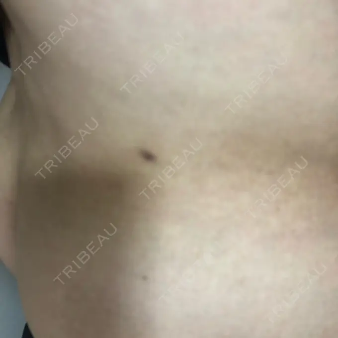 ほくろ・いぼ切除（肌） やさしい美容皮膚科・皮フ科　秋葉原院 DAY 171 メイン用