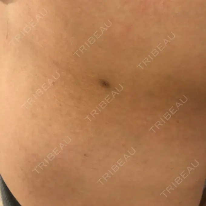 ほくろ・いぼ切除（肌） やさしい美容皮膚科・皮フ科　秋葉原院 DAY 192 メイン用