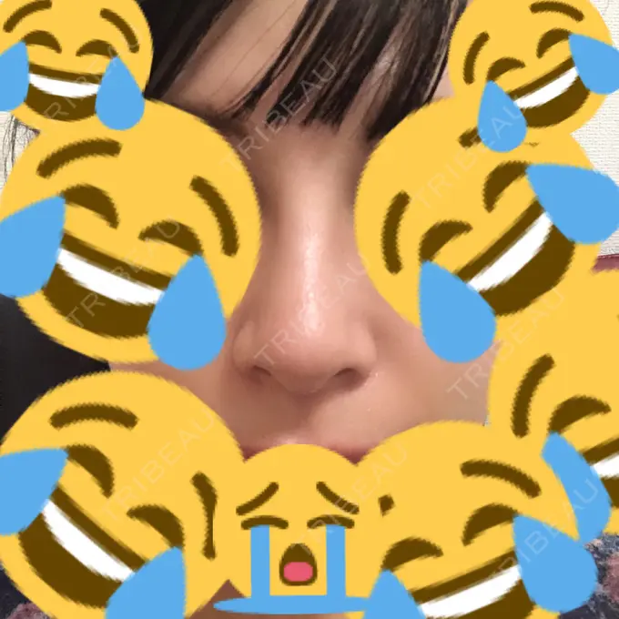 鼻尖形成（切開） / 小鼻縮小（切開） / 軟骨移植 / 骨切幅寄せ / ワシ鼻修正・ハンプ切除 FROM B整形外科 (旧バウム整形外科) DAY 21 メイン用