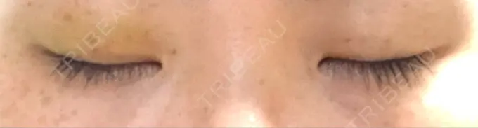 二重埋没 湘南美容クリニック 京都院 DAY 5 メイン用