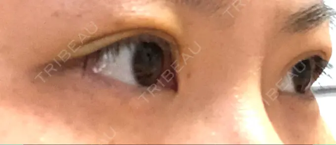 二重埋没 湘南美容クリニック 京都院 DAY 5 メイン用