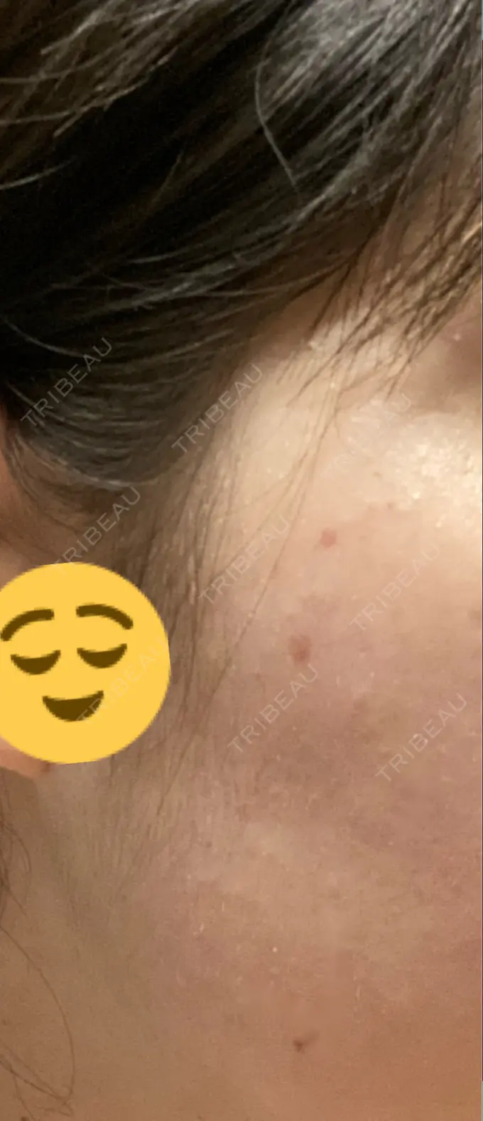 ほくろ・いぼ切除（肌） シンシアガーデンクリニック 太田院 AFTER メイン用