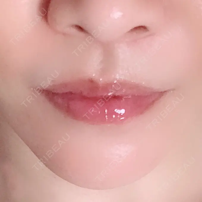 人中短縮 ドクターゴールドマンクリニック 大阪院 AFTER メイン用