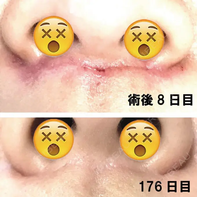人中短縮 ドクターゴールドマンクリニック 大阪院 DAY 176 メイン用