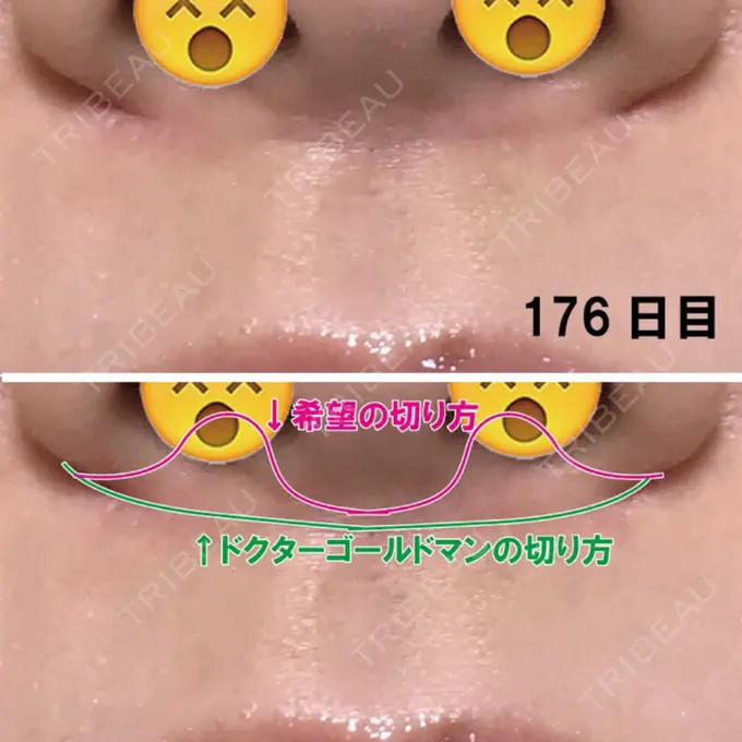 人中短縮 ドクターゴールドマンクリニック 大阪院 DAY 176 メイン用