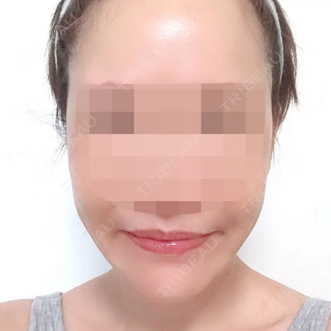 骨切り（あご） / 骨削り（エラ） / 骨削り（頬） シンデレラ美容整形外科 DAY 120 メイン用