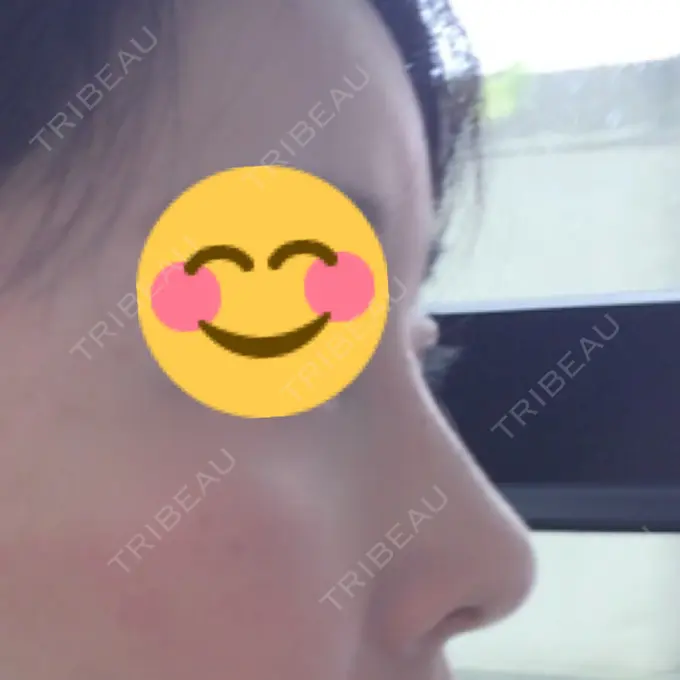 隆鼻術 / 鼻尖形成（切開） / 鼻中隔延長（切開） / 骨切幅寄せ / ワシ鼻修正・ハンプ切除 / ヒアルロン酸溶解 ミナ美容外科 AFTER メイン用