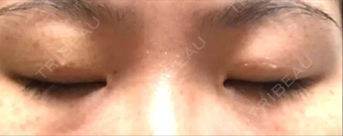 二重埋没 湘南美容クリニック 京都院 DAY 9 メイン用