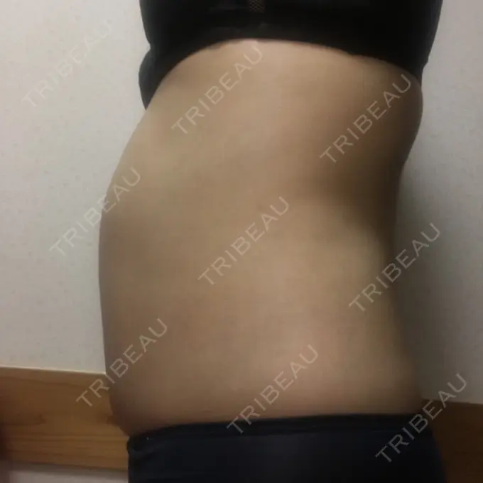 その他（ボディ） 品川美容外科 仙台院 DAY 44 メイン用