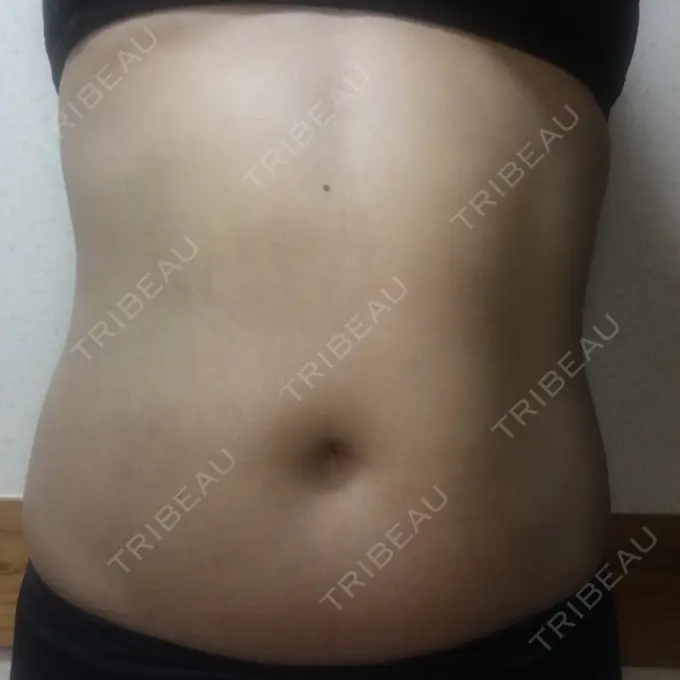 その他（ボディ） 品川美容外科 仙台院 AFTER メイン用