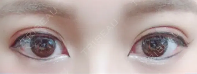 二重埋没 湘南美容クリニック 京都院 DAY 3 メイン用